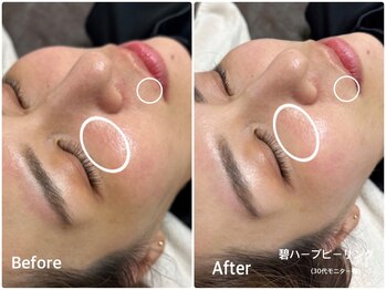 ラウレア(LAULEA)/ハーブピーリンBefore/After