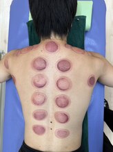 おなが浦添当山整骨院/カッピング（ブーブー）