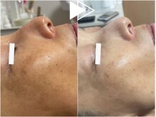 リシェス(Richesse)/シミ改善ハーブ★初回¥9990