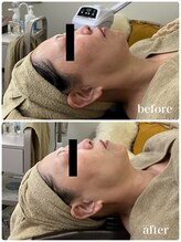 ジャスミン(Jasmin)/たるみ改善コース