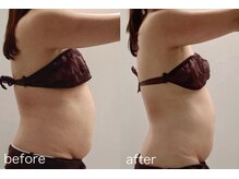 レイジュ(reiju)/【サーモシェイプ　上半身3回】