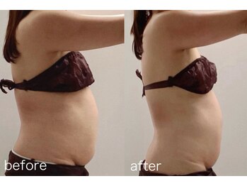 レイジュ(reiju)/【サーモシェイプ　上半身3回】