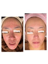 ココ 2号店(CoCo)/ハーブピーリング