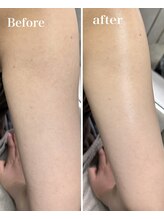 オーパーツ(OOPARTS)/二の腕シェービング/ブライダル