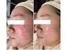 ずっと肌トラブルでお悩みの方へ！本気のニキビケア肌改善エステ
