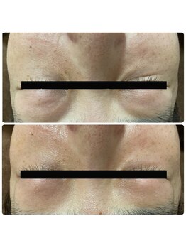 アイリス(AIRIS)/シワ、乾燥にお悩みの方