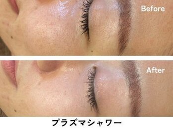 ギルドハナレ(GUILD HANARE)/"プラズマケア"