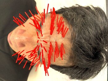 とだ鍼灸院の写真/《深部まで刺すけど痛気持ちイイ!トリガーP鍼》仕事に集中できない程の強い首肩の痛み/コリ/頭痛を解消◎