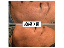 エステサロン ソワンの雰囲気（ハーブピーリングの肌質改善で回数を重ねてお肌が変化！）