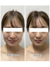 エンチャント(ENCHANT)/小顔造形超音波リフト