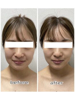 エンチャント(ENCHANT)/小顔造形超音波リフト