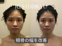 リス(R.i.S)/小顔矯正Before&After