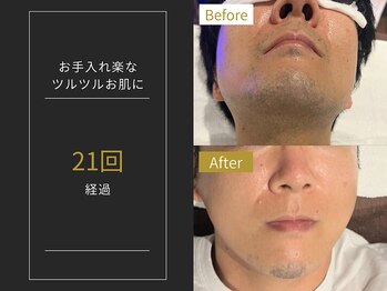 ステイゴールド 新百合ヶ丘(STAY GOLD)/おヒゲ脱毛の経過☆