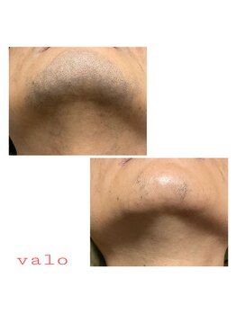 ヴァロ(Valo)/メンズ人気No.1ヒゲ脱毛