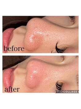 グラシア 宇土店(gracia)/毛穴専門店