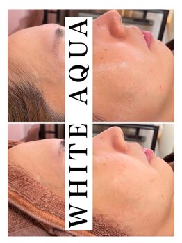 ホワイトアクア つくば店(WHITE AQUA)/ララピール/ つくば/茨城/艶肌