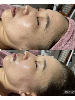 とぅるりん 肌質改善/一度でちゅるん水光肌に♪