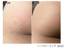 エミルカ 宮崎店(EMILUCA)/【クーポン有】自信持てるヒップ