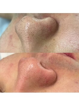 ルピナス 立川店/毛穴洗浄