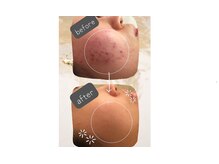 今大人気のAHAピーリングをぜひ体感して下さい。