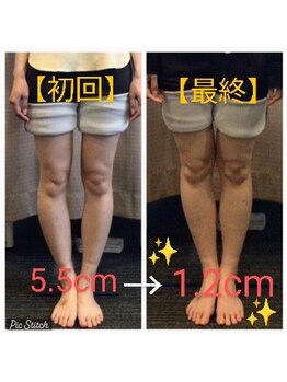 クシロ鍼灸整骨院/【O脚矯正】施術例