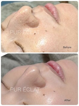 ピュールエクラ(PUR ECLAT)/お肌のお手入れ+リンパ流し♪