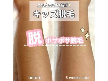 サロン(SALON)/キッズ脱毛：腕