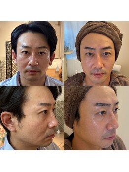 ホロニック ベルサンテ(Holonic Belle Sante)/シミのケア/くすみ/たるみ改善