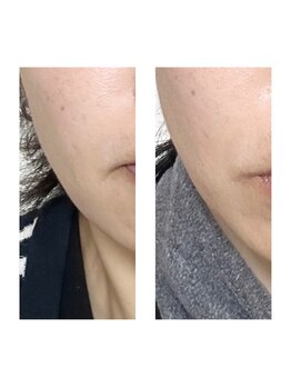 エフ(f)/小顔＆口角も上がるよ～