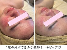 プリュボーテ(Pul Beaute)の雰囲気（熱のこもった赤い肌にはとにかく鎮静を！早めのケアが必要です）