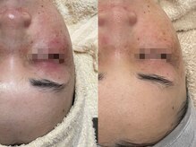 エミュ(emu)/繰り返す赤みにも