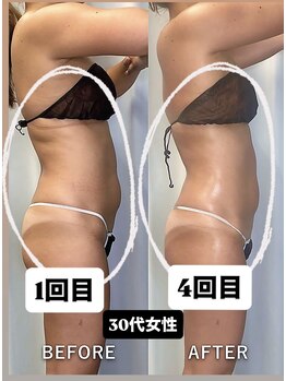 レチカ(Rechica)/吸い上げ（吸引）＋ラジオ波