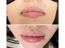 ラナンス 千早(LANUNCE)/ローマピンク施術１回