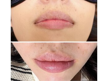 ラナンス 千早(LANUNCE)/ローマピンク施術１回