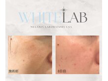 最新！新しいシミケア♪セラムを塗ってベロンと剥がす【小顔】