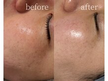 ルーム(lume)/ハーブピーリング before/after