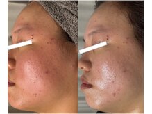 エステ リラクゼーションサロン(more)の雰囲気（冬の乾燥＆春の花粉に負けない！バリア機能を高める陶肌ピール）