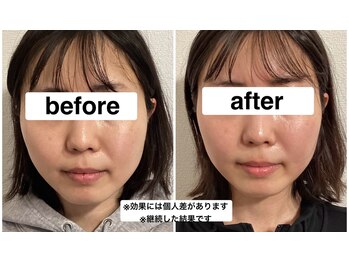 グリーン鍼灸整体院(green鍼灸整体院)/美容鍼(ビフォーアフター)