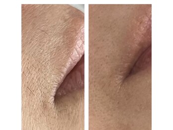 フットミー(foot mii)/産毛、ムダ毛、脱毛