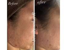 ビューティサロン アール(R)/フェイスライントラブルも改善