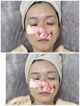 アルカンジュ(Archange)/ツボケアで小顔&美肌効果