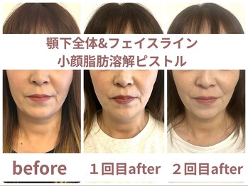 サボラミ(sabor A Mi)/顎下全体&頬/小顔溶解ピストル