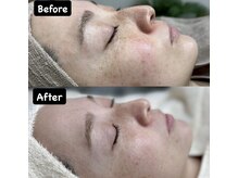 チル(Chill)/【シミ改善】