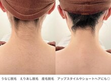 アンシャンテ 芦屋店/芦屋 西宮で美肌脱毛・えりあし