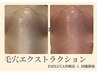 【2回目以降のご来店】毛穴詰まり取り放題メニュー【鼻以外もOK】¥21000