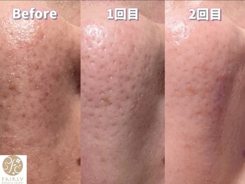 エステティックサロン フェアリー(ESTHETIC SALON FAIRLY)/ハイドロ毛穴レスピーリング