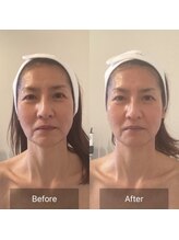 アイビー 二子玉川店(IB)/ほうれい線もリフトアップ！