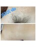 ★男性人気No.1【VIO ブラジリアンwax脱毛】全世代に人気☆ 12,000→9,800