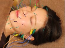 ビファイン鍼灸治療院 梅ヶ丘南口院/美容鍼