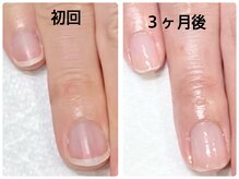 ネイルサロンエマ(EMA)の雰囲気（深爪、平たい爪、むしり癖、二枚爪も育爪ケアで驚きの変化！）